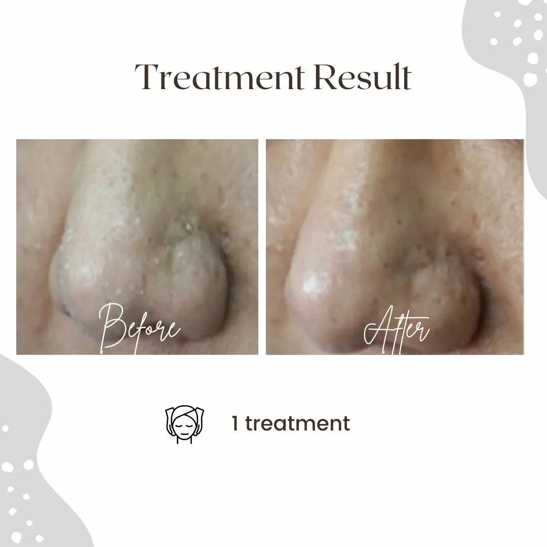 AQUA LAB - Deep Cleaning & Peeling Device (Korean Hydro Facial)