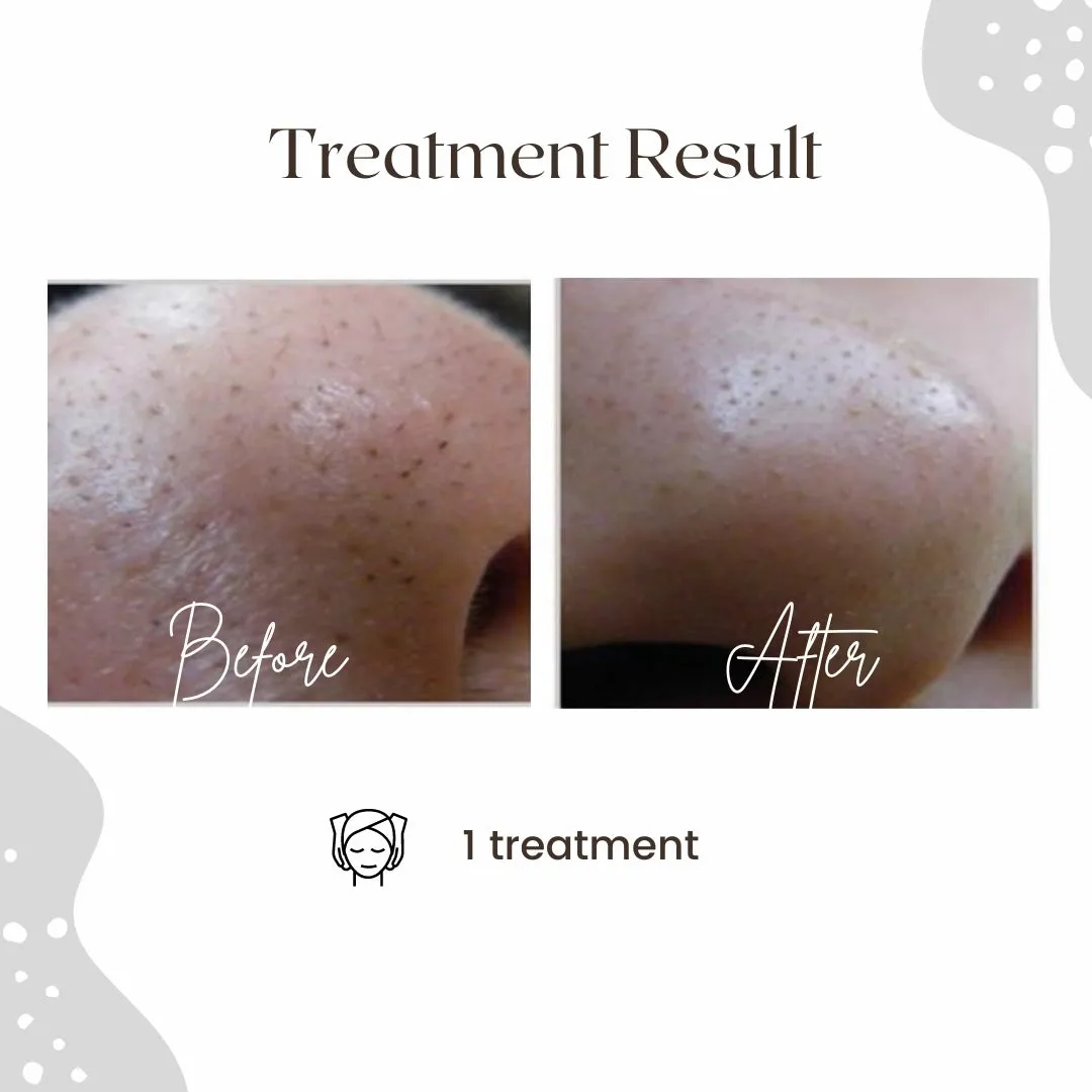 AQUA LAB - Deep Cleaning & Peeling Device (Korean Hydro Facial)